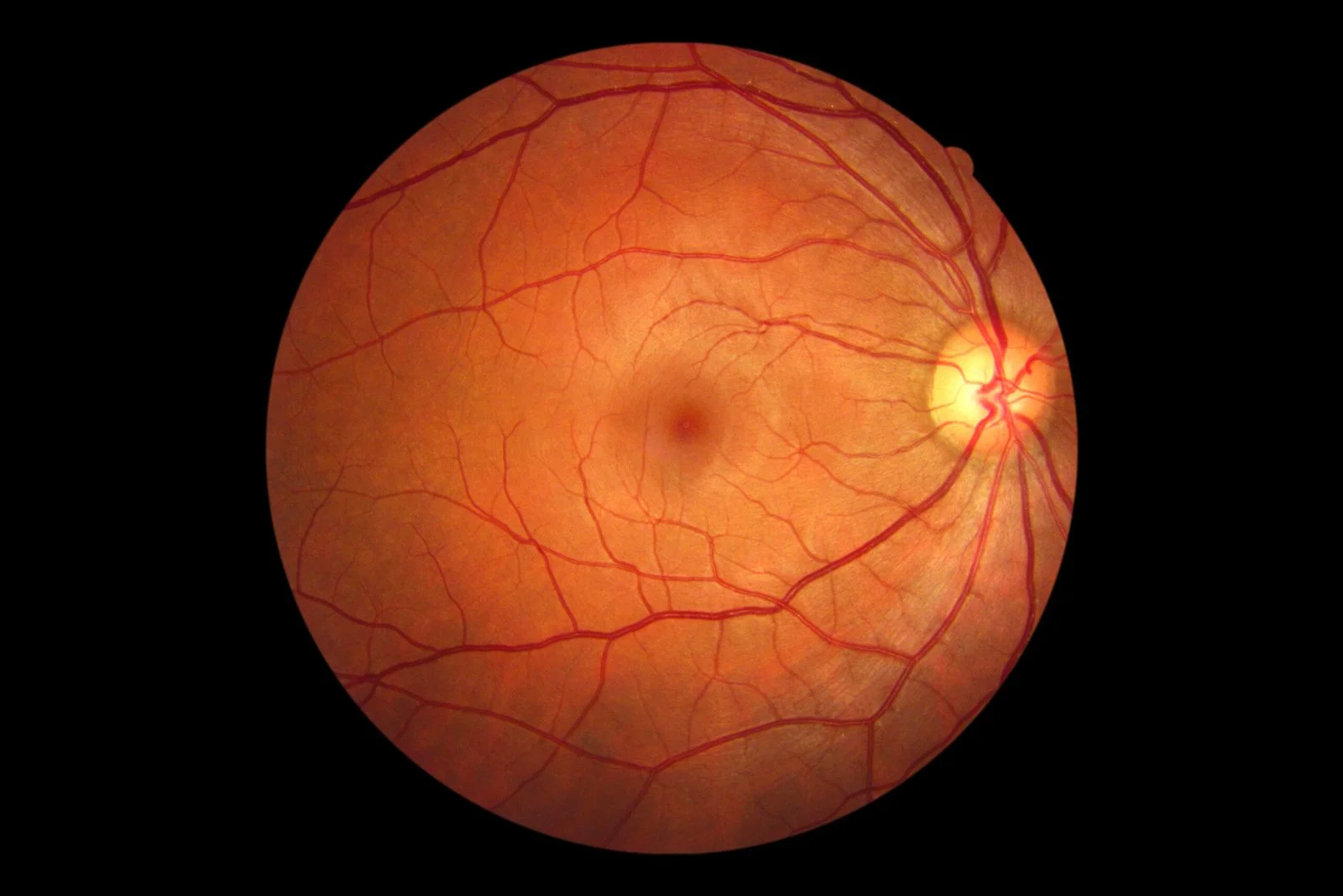 Foto de fundus (Fundus)
