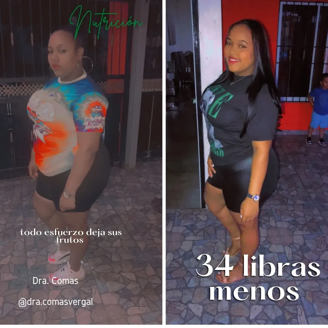 Paciente bariátrico antes tratamiento