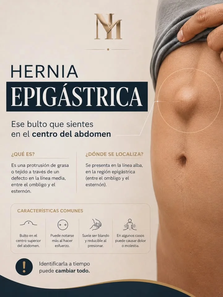 Infografía sobre la hernia epigástrica: qué es, dónde se localiza y características