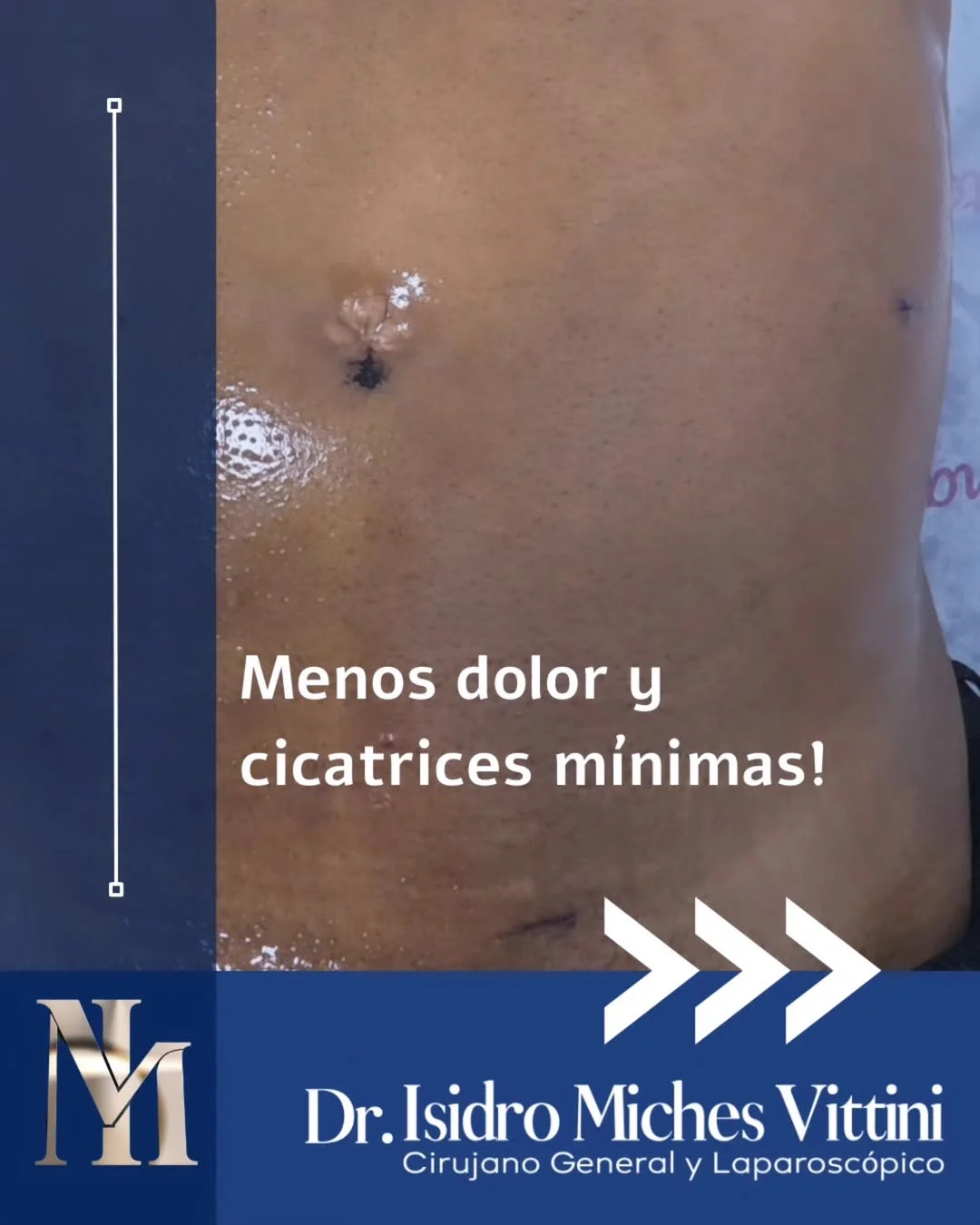 Abdomen tras cirugía laparoscópica con incisiones milimétricas