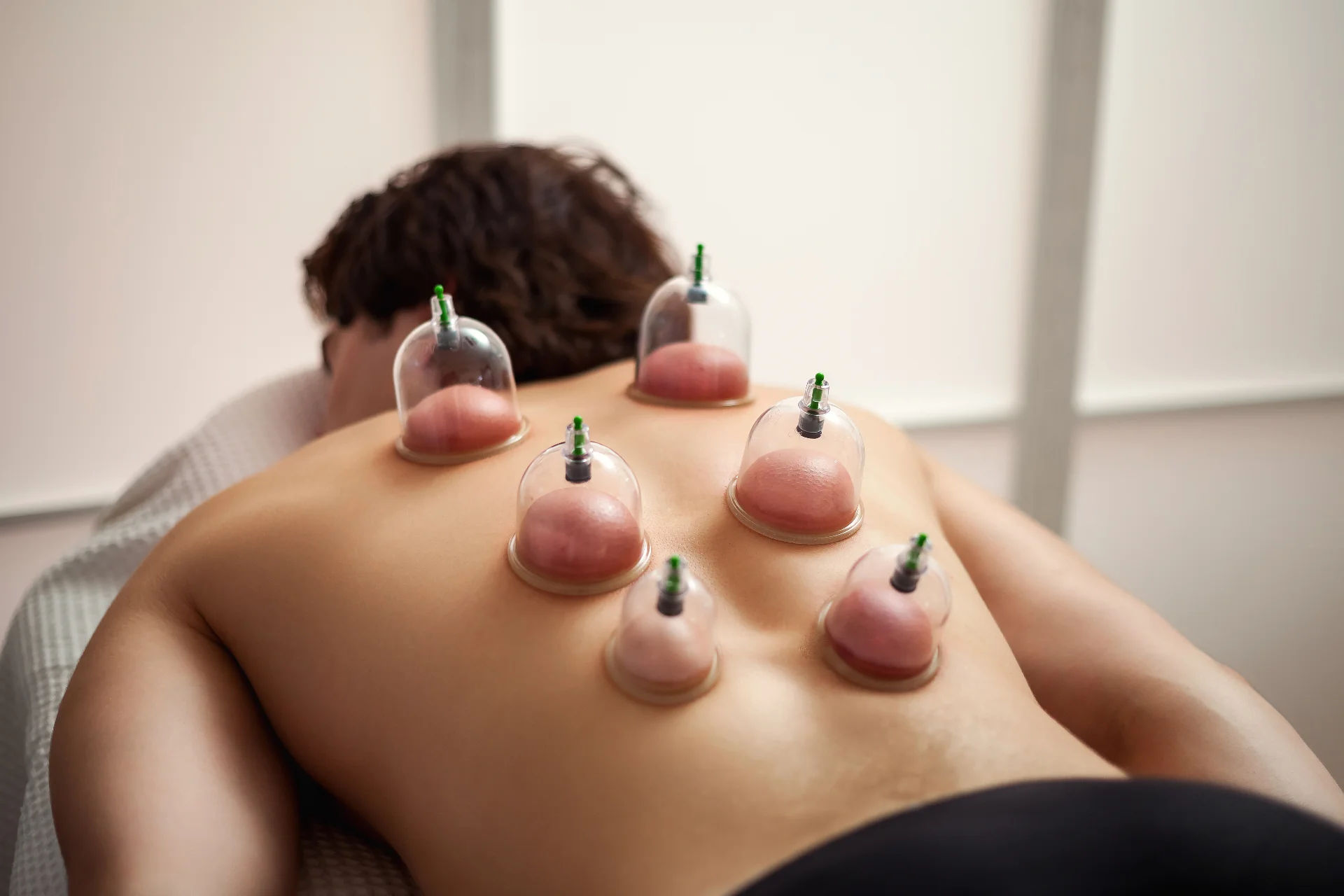 Cupping
